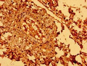Immunohistochemistry of paraffin-embedded human lung tissue using SEMA5B Antibody at dilution of 1:100
