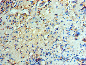 Immunohistochemistry of paraffin-embedded human prostate cancer using EIF2AK4 Antibody at dilution of 1:100Rabbit anti-Human EIF2AK4 Polyclonal Antibody