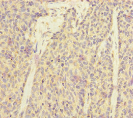 Immunohistochemistry of paraffin-embedded human ovarian cancer using SUCLA2 Antibody at dilution of 1:100Rabbit anti-Human SUCLA2 Polyclonal Antibody