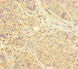 Immunohistochemistry of paraffin-embedded human ovarian cancer using SUCLA2 Antibody at dilution of 1:100Rabbit anti-Human SUCLA2 Polyclonal Antibody