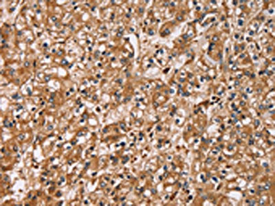 The image on the left is immunohistochemistry of paraffin-embedded Human prostate cancer tissue using the antibody Antibody) at dilution 1/30, on the right is treated with fusion protein. (Original magnification: ×200)Rabbit anti-Human HTR3C Polyclonal Antibody