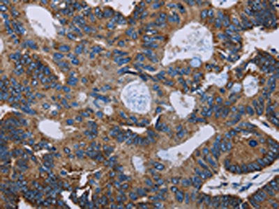 The image on the left is immunohistochemistry of paraffin-embedded Human colon cancer tissue using F11R Antibody(F11R Antibody) at dilution 1/60, on the right is treated with fusion protein. (Original magnification: ×200)Rabbit anti-Human F11R Polyclonal Antibody