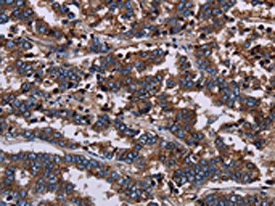The image on the left is immunohistochemistry of paraffin-embedded Human liver cancer tissue using the antibody Antibody) at dilution 1/60, on the right is treated with fusion protein. (Original magnification: ×200)Rabbit anti-Human F11R Polyclonal Antibody