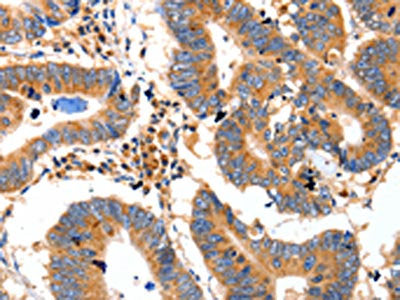 The image on the left is immunohistochemistry of paraffin-embedded Human colon cancer tissue using the antibody Antibody) at dilution 1/20, on the right is treated with fusion protein. (Original magnification: ×200)Rabbit anti-Human IDE Polyclonal Antibody