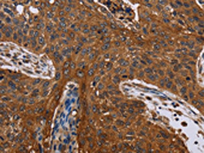 The image on the left is immunohistochemistry of paraffin-embedded Human lung cancer tissue using JUP Antibody(JUP Antibody) at dilution 1/40, on the right is treated with fusion protein. (Original magnification: ×200)