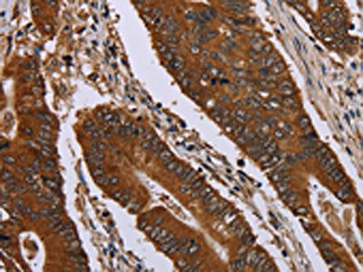 The image on the left is immunohistochemistry of paraffin-embedded Human colon cancer tissue using the antibody Antibody) at dilution 1/40, on the right is treated with fusion protein. (Original magnification: ×200)