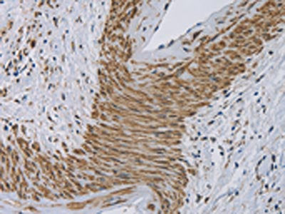 The image on the left is immunohistochemistry of paraffin-embedded Human cervical cancer tissue using CYB5A Antibody(CYB5A Antibody) at dilution 1/30, on the right is treated with fusion protein. (Original magnification: ×200)Rabbit anti-Human CYB5A Polyclonal Antibody