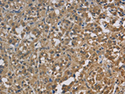 The image on the left is immunohistochemistry of paraffin-embedded Human thyroid cancer tissue using the antibody Antibody) at dilution 1/30, on the right is treated with fusion protein. (Original magnification: ×200)Rabbit anti-Human CYB5A Polyclonal Antibody