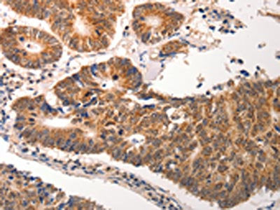 The image on the left is immunohistochemistry of paraffin-embedded Human colon cancer tissue using CDC6 Antibody(CDC6 Antibody) at dilution 1/25, on the right is treated with synthetic peptide. (Original magnification: ×200)Rabbit anti-Human CDC6 Polyclonal Antibody