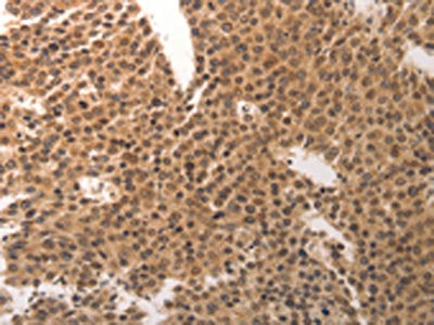 The image on the left is immunohistochemistry of paraffin-embedded Human breast cancer tissue using the antibody Antibody) at dilution 1/25, on the right is treated with synthetic peptide. (Original magnification: ×200)Rabbit anti-Human CDC6 Polyclonal Antibody