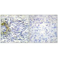 Immunohistochemistry analysis of paraffin-embedded human lung carcinoma tissue using FXR2 antibody.Rabbit anti-Human FXR2 Polyclonal Antibody