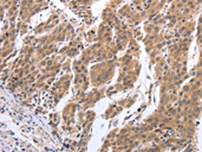 The image on the left is immunohistochemistry of paraffin-embedded Human breast cancer tissue using GEMIN2 Antibody(GEMIN2 Antibody) at dilution 1/40, on the right is treated with synthetic peptide. (Original magnification: ×200)Rabbit anti-Human GEMIN2 Polyclonal Antibody