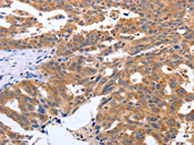 The image on the left is immunohistochemistry of paraffin-embedded Human ovarian cancer tissue using the antibody Antibody) at dilution 1/40, on the right is treated with synthetic peptide. (Original magnification: ×200)Rabbit anti-Human GEMIN2 Polyclonal Antibody