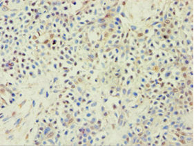 Immunohistochemistry of paraffin-embedded human breast cancer using ABCF2 Antibody at dilution of 1:100