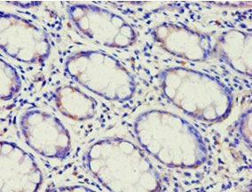 Immunohistochemistry of paraffin-embedded human colon cancer using ABCF2 Antibody at dilution of 1:100