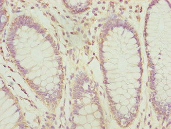 Immunohistochemistry of paraffin-embedded human colon cancer using PDCD2L Antibody at dilution of 1:100Rabbit anti-Human PDCD2L Polyclonal Antibody