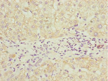 Immunohistochemistry of paraffin-embedded human liver cancer using PDCD2L Antibody at dilution of 1:100Rabbit anti-Human PDCD2L Polyclonal Antibody