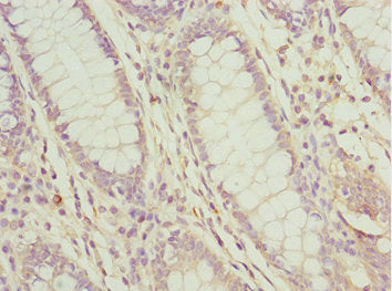 Immunohistochemistry of paraffin-embedded human colon cancer using PDCD2L Antibody at dilution of 1:100Rabbit anti-Human PDCD2L Polyclonal Antibody