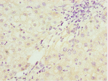 Immunohistochemistry of paraffin-embedded human liver cancer using PDCD2L Antibody at dilution of 1:100Rabbit anti-Human PDCD2L Polyclonal Antibody
