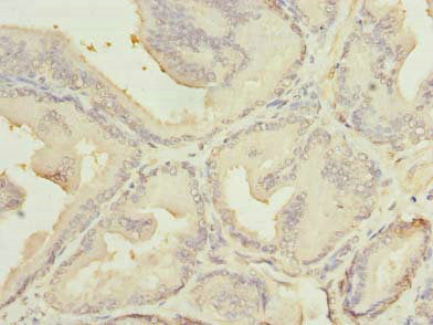 Immunohistochemistry of paraffin-embedded human prostate cancer using MED18 Antibody at dilution of 1:100