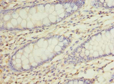 Immunohistochemistry of paraffin-embedded human colon cancer using the antibody at dilution of 1:100Rabbit anti-Human RUSC1 Polyclonal Antibody