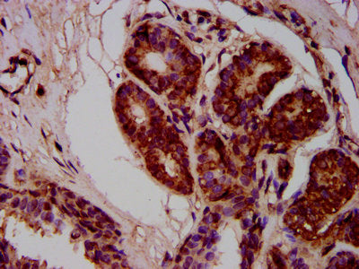 IHC image of MOV10L1 Antibody diluted at 1:400 and staining in paraffin-embedded human breast cancer performed on a Leica BondTM system. After dewaxing and hydration, antigen retrieval was mediated by high pressure in a citrate buffer (pH 6.0). Section was blocked with 10% normal goat serum 30min at RT. Then primary antibody (1% BSA) was incubated at 4°C overnight. The primary is detected by a biotinylated secondary antibody and visualized using an HRP conjugated SP system.