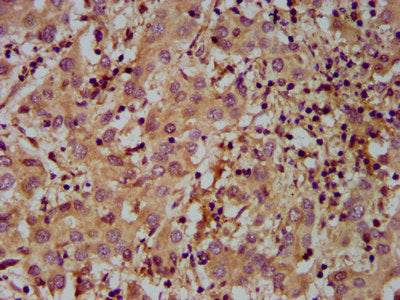 IHC image of MOV10L1 Antibody diluted at 1:400 and staining in paraffin-embedded human liver cancer performed on a Leica BondTM system. After dewaxing and hydration, antigen retrieval was mediated by high pressure in a citrate buffer (pH 6.0). Section was blocked with 10% normal goat serum 30min at RT. Then primary antibody (1% BSA) was incubated at 4°C overnight. The primary is detected by a biotinylated secondary antibody and visualized using an HRP conjugated SP system.