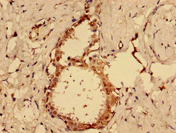 Immunohistochemistry of paraffin-embedded human ovarian cancer using MKRN2 Antibody at dilution of 1:100