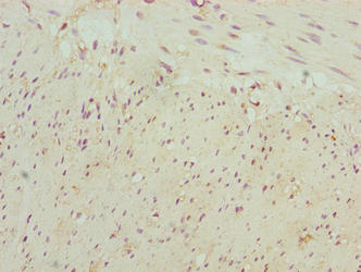 Immunohistochemistry of paraffin-embedded human colon tissue using NBPF3 Antibody at dilution of 1:100Rabbit anti-Human NBPF3 Polyclonal Antibody