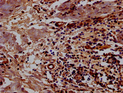 Immunohistochemistry of paraffin-embedded human breast cancer using the antibody at dilution of 1:100