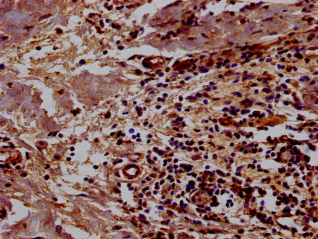Immunohistochemistry of paraffin-embedded human breast cancer using the antibody at dilution of 1:100