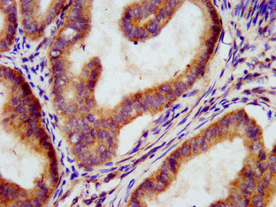 IHC image of MEGF9 Antibody diluted at 1:300 and staining in paraffin-embedded human endometrial cancer performed on a Leica BondTM system. After dewaxing and hydration, antigen retrieval was mediated by high pressure in a citrate buffer (pH 6.0). Section was blocked with 10% normal goat serum 30min at RT. Then primary antibody (1% BSA) was incubated at 4°C overnight. The primary is detected by a biotinylated secondary antibody and visualized using an HRP conjugated SP system.