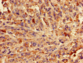 Immunohistochemistry of paraffin-embedded human melanoma using BLZF1 Antibody at dilution of 1:100