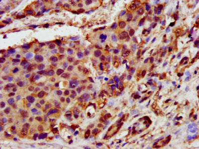 IHC image of GHITM Antibody diluted at 1:400 and staining in paraffin-embedded human pancreatic cancer performed on a Leica BondTM system. After dewaxing and hydration, antigen retrieval was mediated by high pressure in a citrate buffer (pH 6.0). Section was blocked with 10% normal goat serum 30min at RT. Then primary antibody (1% BSA) was incubated at 4°C overnight. The primary is detected by a biotinylated secondary antibody and visualized using an HRP conjugated SP system.Rabbit anti-Human GHITM Polyclonal Antibody