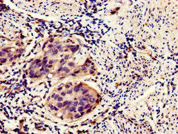 Immunohistochemistry of paraffin-embedded human bladder cancer using the antibody at dilution of 1:100Rabbit anti-Human HIPK3 Polyclonal Antibody