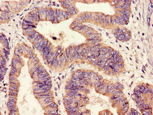 Immunohistochemistry of paraffin-embedded human colon cancer using HIPK3 Antibody at dilution of 1:100Rabbit anti-Human HIPK3 Polyclonal Antibody