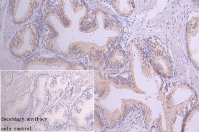 Immunohistochemistry of paraffin-embedded human prostate cancer using GOLPH3 Antibody at dilution of 1:100Rabbit anti-Human GOLPH3 Polyclonal Antibody