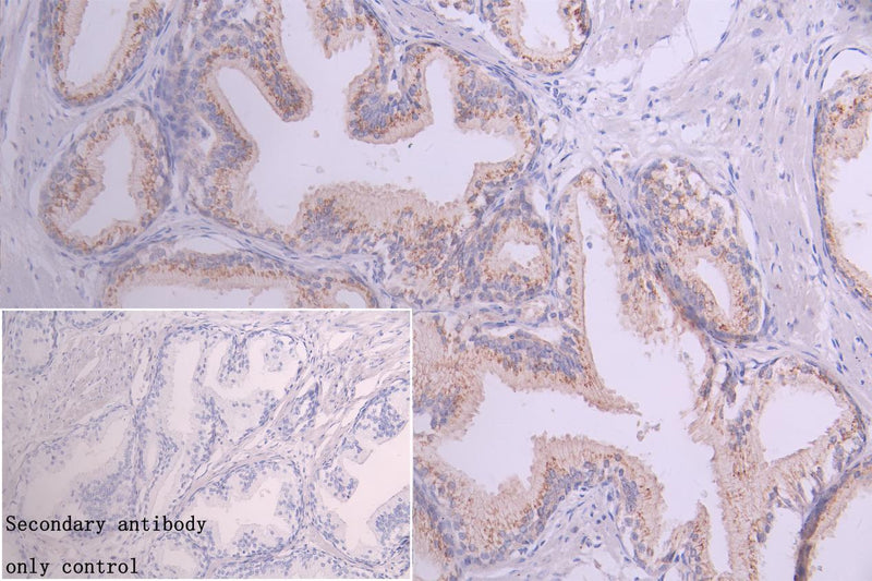 Immunohistochemistry of paraffin-embedded human prostate cancer using GOLPH3 Antibody at dilution of 1:100Rabbit anti-Human GOLPH3 Polyclonal Antibody
