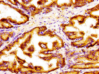 Immunohistochemistry of paraffin-embedded human prostate tissue using GOLPH3 Antibody at dilution of 1:100Rabbit anti-Human GOLPH3 Polyclonal Antibody