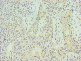 Immunohistochemistry of paraffin-embedded human breast cancer using SUV39H2 Antibody at dilution of 1:100Rabbit anti-Human SUV39H2 Polyclonal Antibody