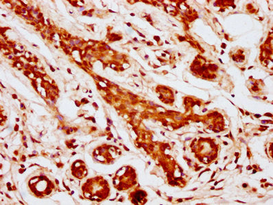 IHC image of MOB1A Antibody diluted at 1:1000 and staining in paraffin-embedded human breast cancer performed on a Leica BondTM system. After dewaxing and hydration, antigen retrieval was mediated by high pressure in a citrate buffer (pH 6.0). Section was blocked with 10% normal goat serum 30min at RT. Then primary antibody (1% BSA) was incubated at 4°C overnight. The primary is detected by a biotinylated secondary antibody and visualized using an HRP conjugated SP system.Rabbit anti-Human MOB1A Polyclonal Antibody