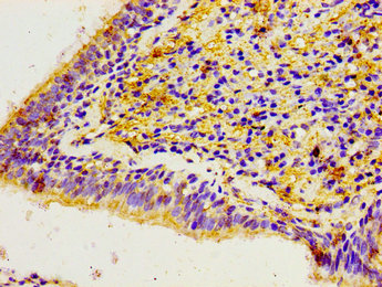 Immunohistochemistry of paraffin-embedded human lung cancer using CACYBP Antibody at dilution of 1:100