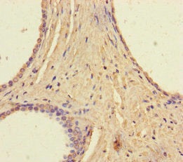 Immunohistochemistry of paraffin-embedded human prostate cancer using the antibody at dilution of 1:100Rabbit anti-Human RAVER2 Polyclonal Antibody