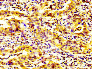 IHC image of the antibody diluted at 1:600 and staining in paraffin-embedded human bladder cancer performed on a Leica BondTM system. After dewaxing and hydration, antigen retrieval was mediated by high pressure in a citrate buffer (pH 6.0). Section was blocked with 10% normal goat serum 30min at RT. Then primary antibody (1% BSA) was incubated at 4°C overnight. The primary is detected by a biotinylated secondary antibody and visualized using an HRP conjugated SP system.Rabbit anti-Human GP6 Polyclonal Antibody