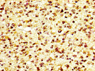 IHC image of GP6 Antibody diluted at 1:600 and staining in paraffin-embedded human glioma performed on a Leica BondTM system. After dewaxing and hydration, antigen retrieval was mediated by high pressure in a citrate buffer (pH 6.0). Section was blocked with 10% normal goat serum 30min at RT. Then primary antibody (1% BSA) was incubated at 4°C overnight. The primary is detected by a biotinylated secondary antibody and visualized using an HRP conjugated SP system.Rabbit anti-Human GP6 Polyclonal Antibody