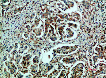 Immunohistochemical analysis of paraffin-embedded human-breast-cancer, antibody was diluted at 1:200Rabbit anti-Human HSPA5 Polyclonal Antibody