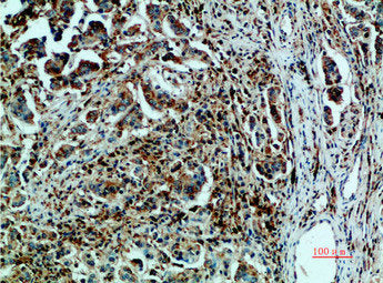 Immunohistochemical analysis of paraffin-embedded human-breast-cancer, antibody was diluted at 1:200Rabbit anti-Human HSPA5 Polyclonal Antibody
