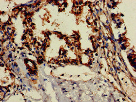Immunohistochemistry of paraffin-embedded human lung tissue using CD209 Antibody at dilution of 1:100Rabbit anti-Human CD209 Polyclonal Antibody