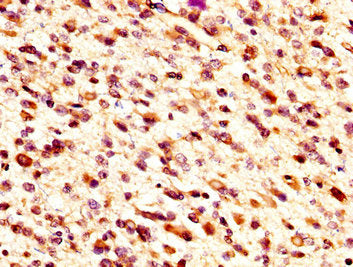 IHC image of MID1IP1 Antibody diluted at 1:300 and staining in paraffin-embedded human glioma performed on a Leica BondTM system. After dewaxing and hydration, antigen retrieval was mediated by high pressure in a citrate buffer (pH 6.0). Section was blocked with 10% normal goat serum 30min at RT. Then primary antibody (1% BSA) was incubated at 4°C overnight. The primary is detected by a biotinylated secondary antibody and visualized using an HRP conjugated SP system.