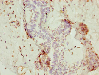 Immunohistochemistry of paraffin-embedded human breast cancer using NOP10 Antibody at dilution of 1:100Rabbit anti-Human NOP10 Polyclonal Antibody